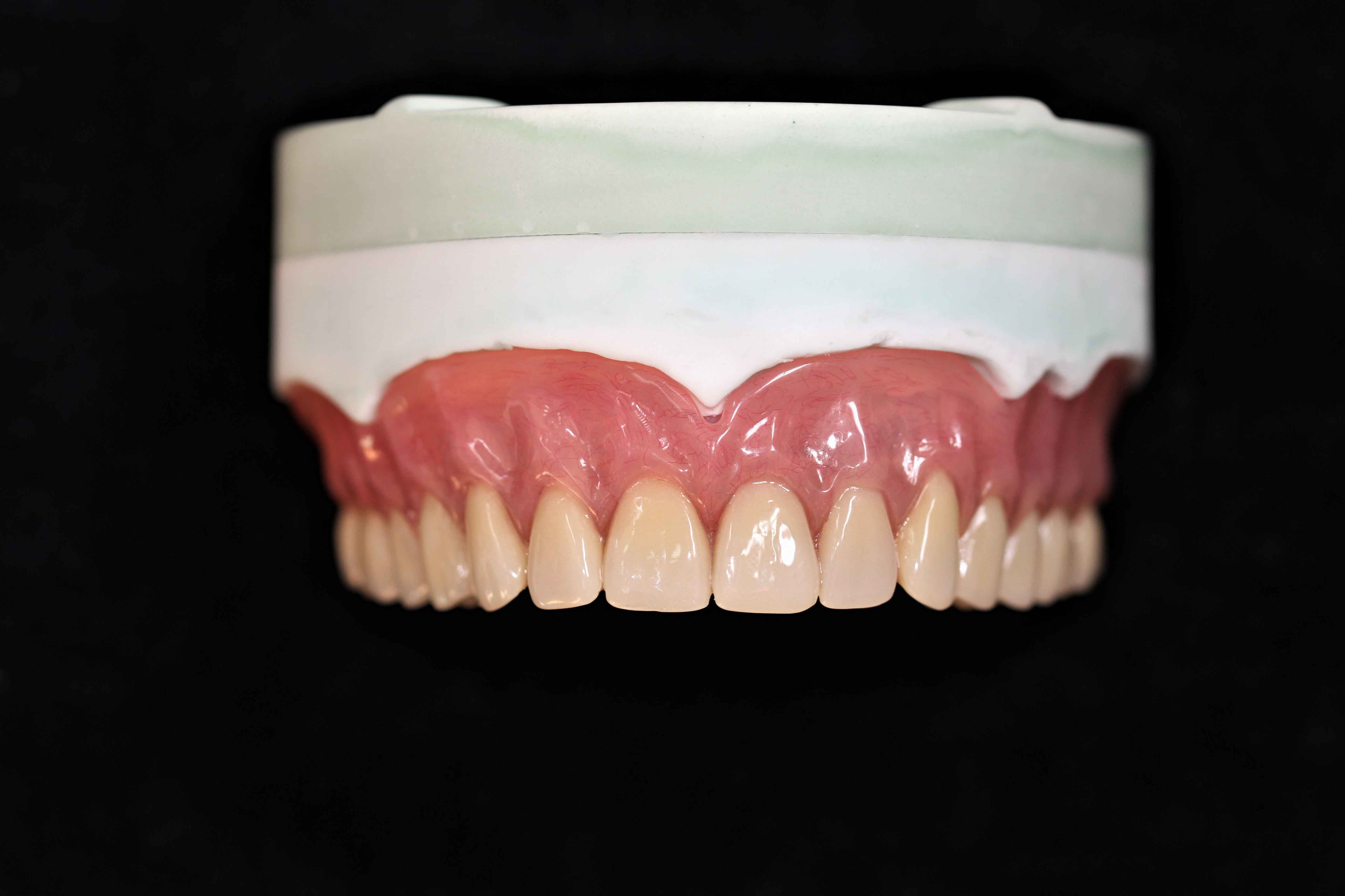 China dental lab determination of vertical distance of full denture