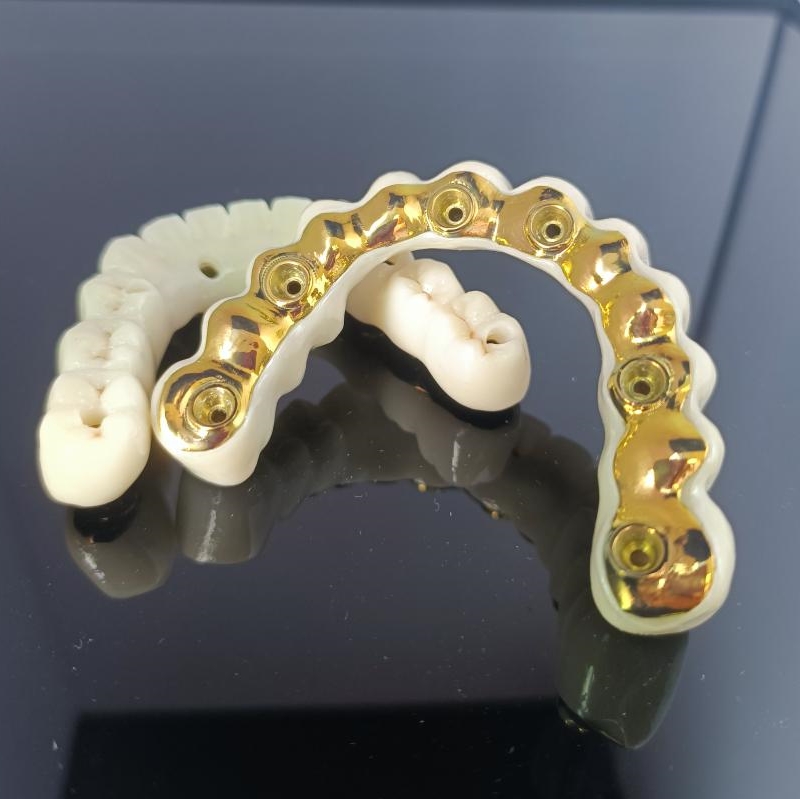 All On X Hybrid Bridge - Full Zirconia Bridge over Titanium Bar